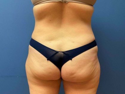 Tummy Tuck Before & After
