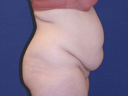 Tummy Tuck Before & After