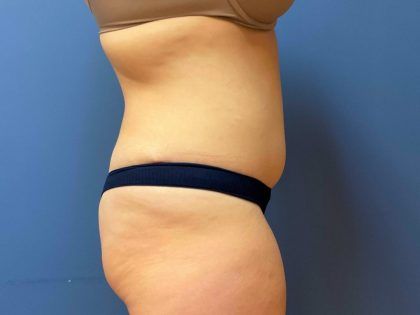 Tummy Tuck Before & After