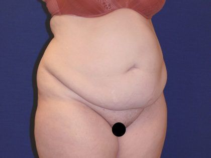 Tummy Tuck Before & After