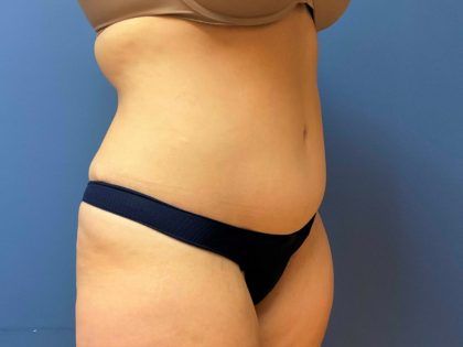 Tummy Tuck Before & After