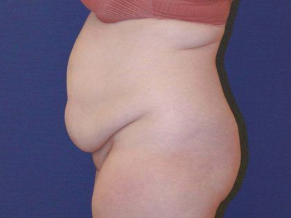 Tummy Tuck Before & After