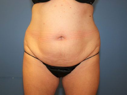 Tummy Tuck Before & After