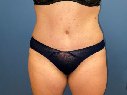 Tummy Tuck Before & After
