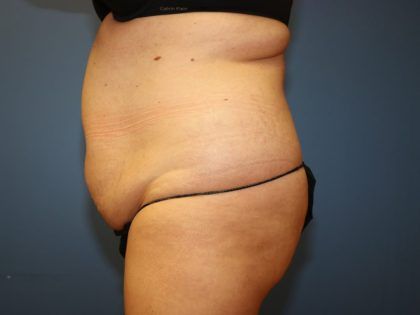 Tummy Tuck Before & After