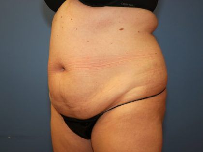 Tummy Tuck Before & After