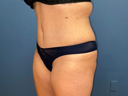 Tummy Tuck Before & After