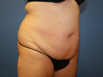 Tummy Tuck Before & After