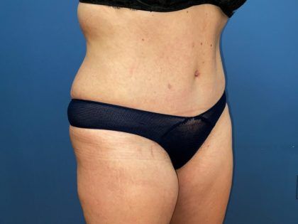 Tummy Tuck Before & After