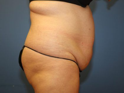 Tummy Tuck Before & After