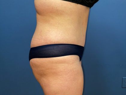 Tummy Tuck Before & After
