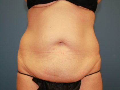 Tummy Tuck Before & After