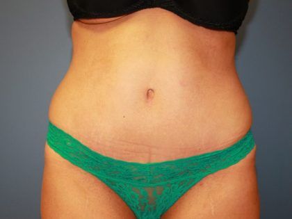 Tummy Tuck Before & After