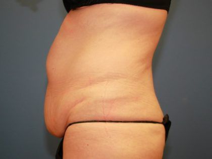 Tummy Tuck Before & After