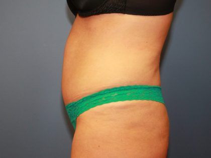 Tummy Tuck Before & After
