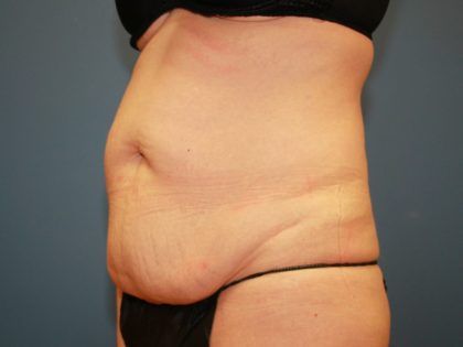 Tummy Tuck Before & After