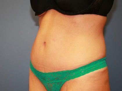 Tummy Tuck Before & After
