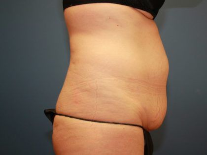Tummy Tuck Before & After