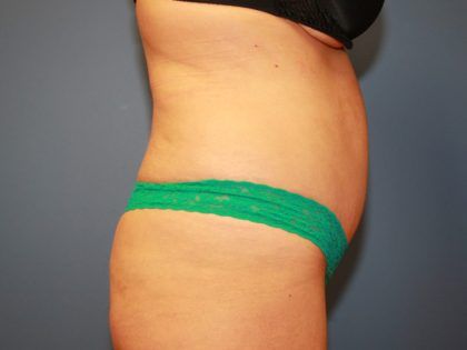 Tummy Tuck Before & After
