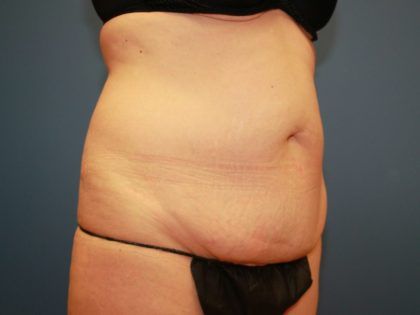 Tummy Tuck Before & After