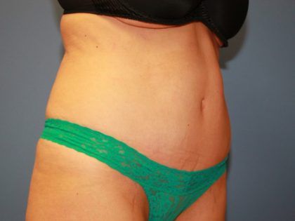 Tummy Tuck Before & After