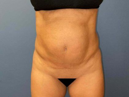 Tummy Tuck Before & After