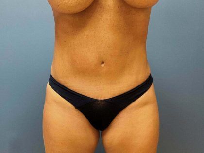 Tummy Tuck Before & After