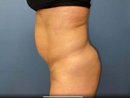 Tummy Tuck Before & After