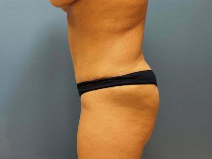 Tummy Tuck Before & After