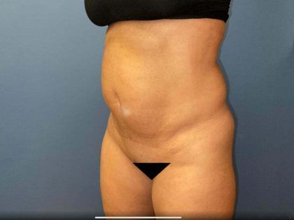 Tummy Tuck Before & After