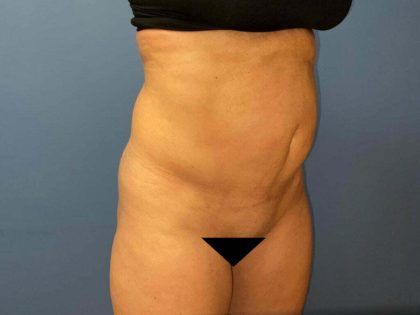 Tummy Tuck Before & After