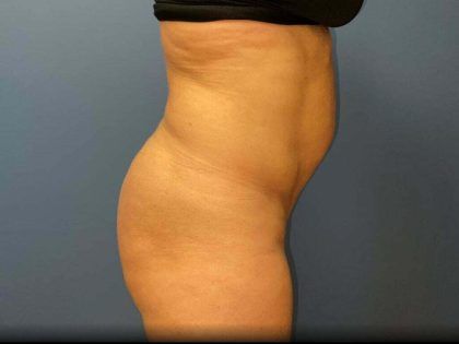 Tummy Tuck Before & After