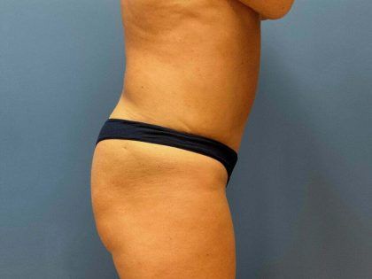 Tummy Tuck Before & After