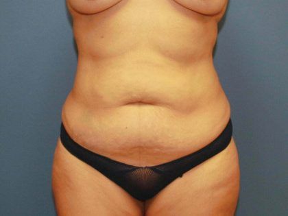 Tummy Tuck Before & After