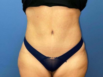 Tummy Tuck Before & After