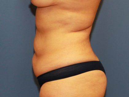 Tummy Tuck Before & After