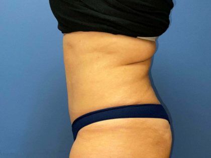Tummy Tuck Before & After