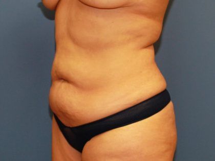 Tummy Tuck Before & After