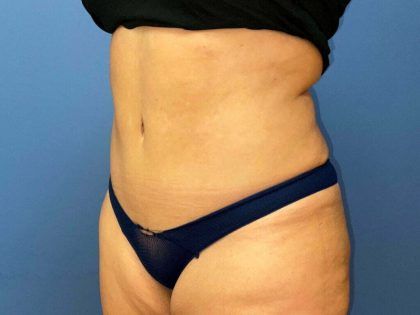 Tummy Tuck Before & After