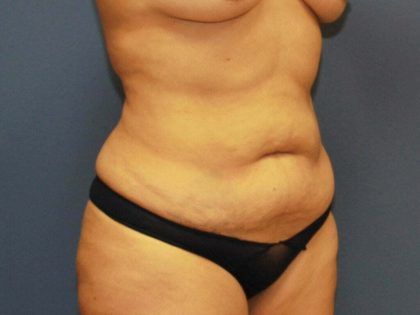 Tummy Tuck Before & After