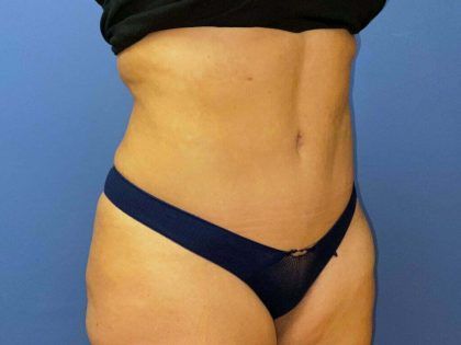 Tummy Tuck Before & After