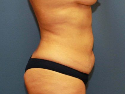 Tummy Tuck Before & After