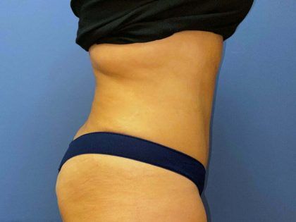 Tummy Tuck Before & After