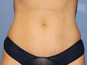 Tummy Tuck Before & After