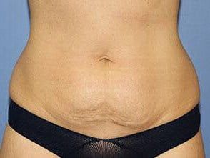 Tummy Tuck Before & After