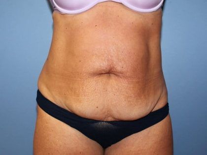 Tummy Tuck Before & After