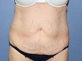 Tummy Tuck Before & After