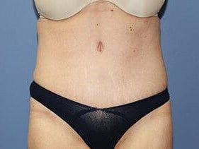 Tummy Tuck Before & After