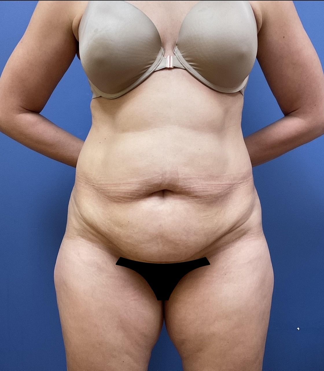 Tummy Tuck Before & After