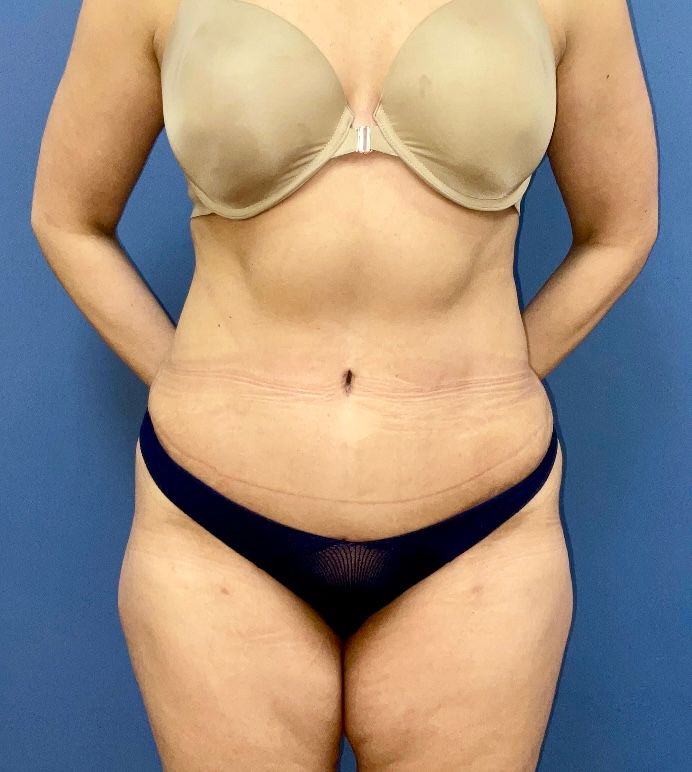 Tummy Tuck Before & After